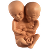 Formaldehyde Skin Siamese Twin Specimen