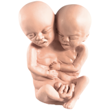 Latex Formaldehyde Skin Siamese Twin Fetus