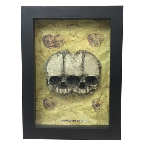 Framed Siamese Twin Triclops Fetus Skull